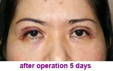 plastic-surgery-blepharoplasty